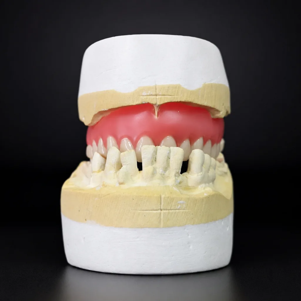Full denture on casts