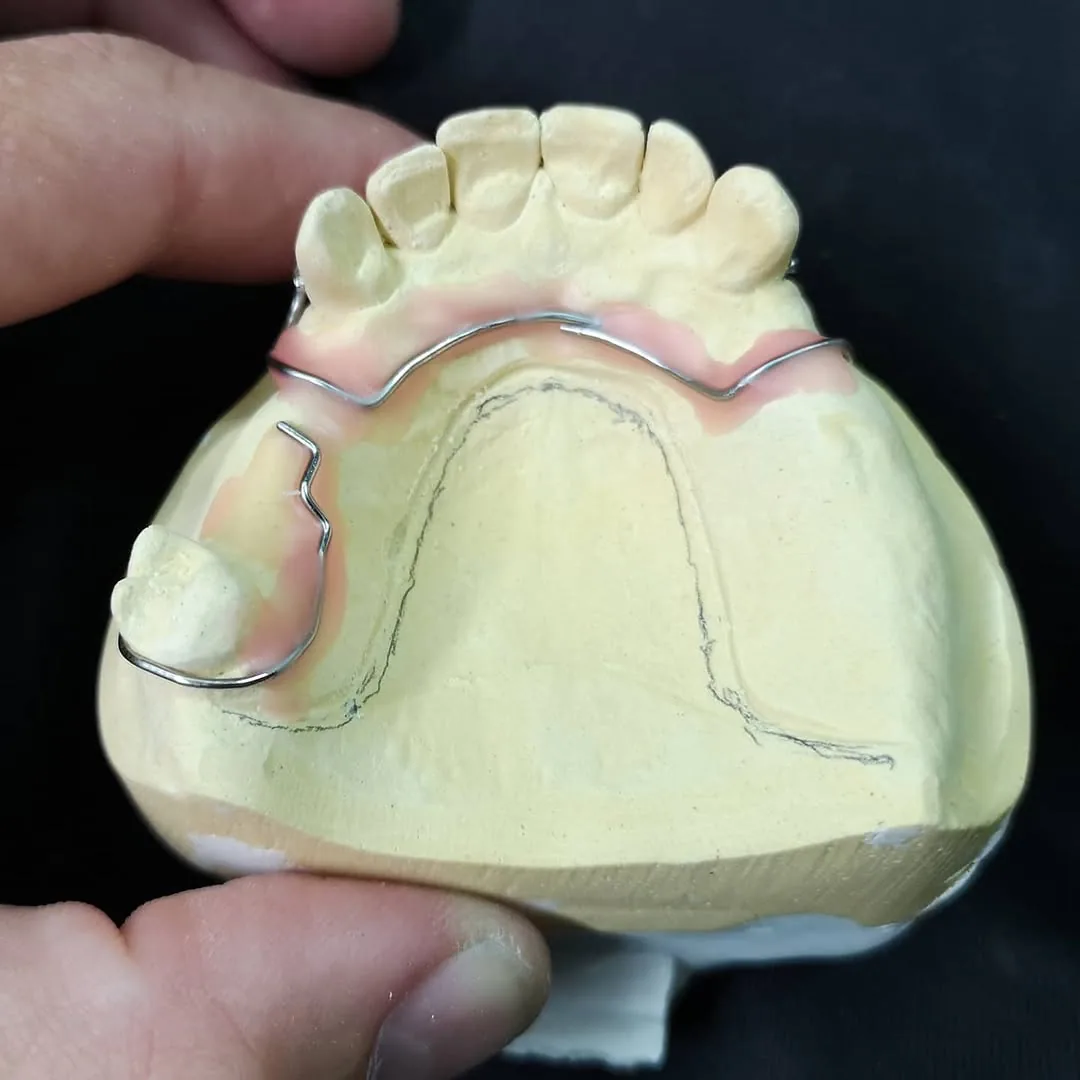 Chrome cobalt removable partial denture framework on working cast
