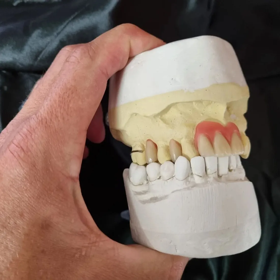 Denture tooth set-up on model