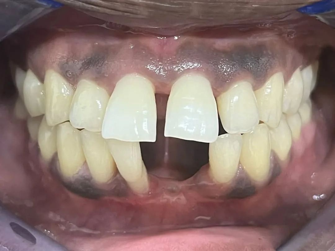 Full denture try-in
