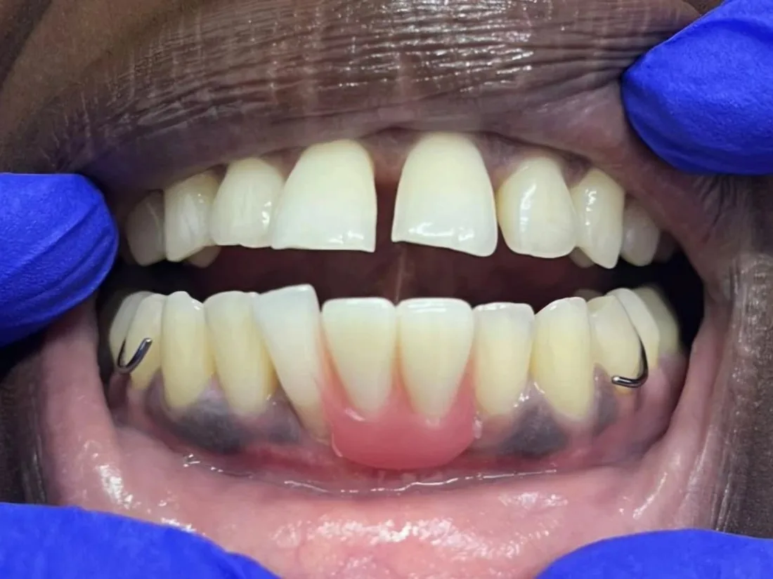 Flexible partial denture fitted in the mouth