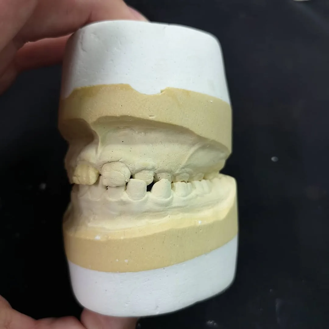 Removable Hawley orthodontic appliance on cast