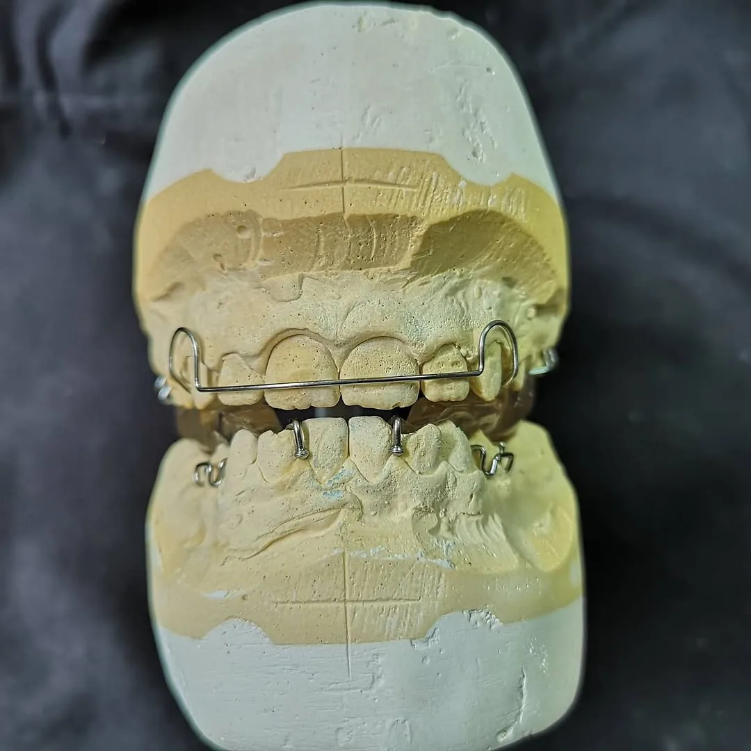 Twin-block orthodontic appliance on articulated casts