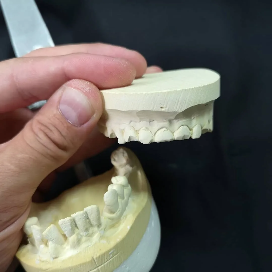 Working cast prepared for a partial denture